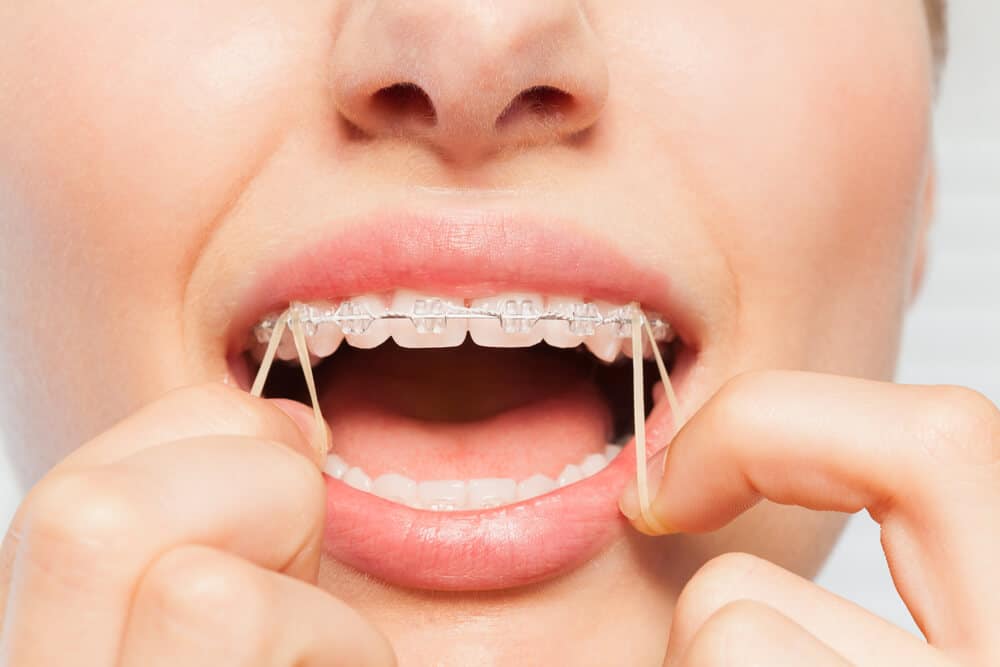 Why Do Braces Hurt and How Can You Relieve the Pain?