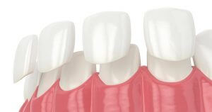 how to whiten porcelain crowns