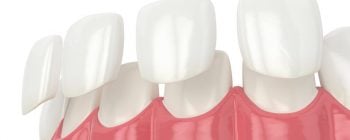 how to whiten porcelain crowns