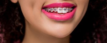 dental insurance for braces