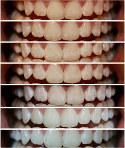 teeth whitening smile brilliant