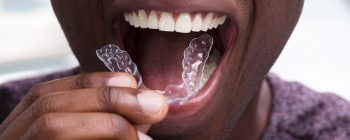 suresmile aligners reviews