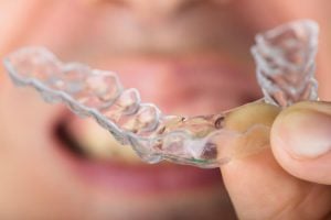 how to close a gap in your teeth at home