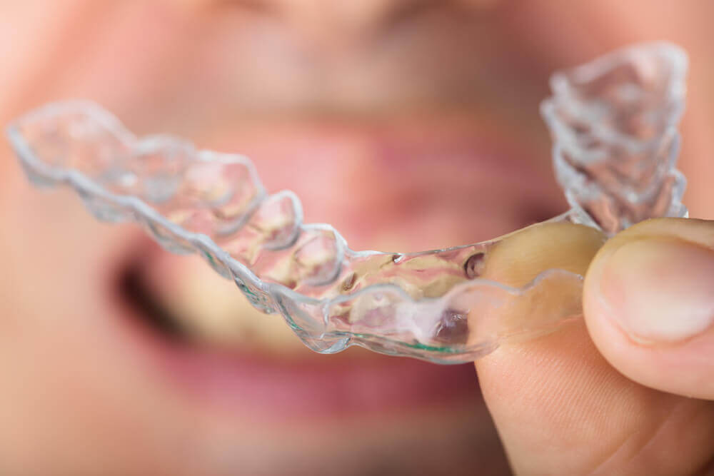 How to Straighten Teeth at Home With Aligners and DIY Kits