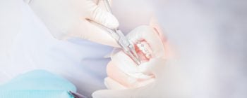 how to remove braces