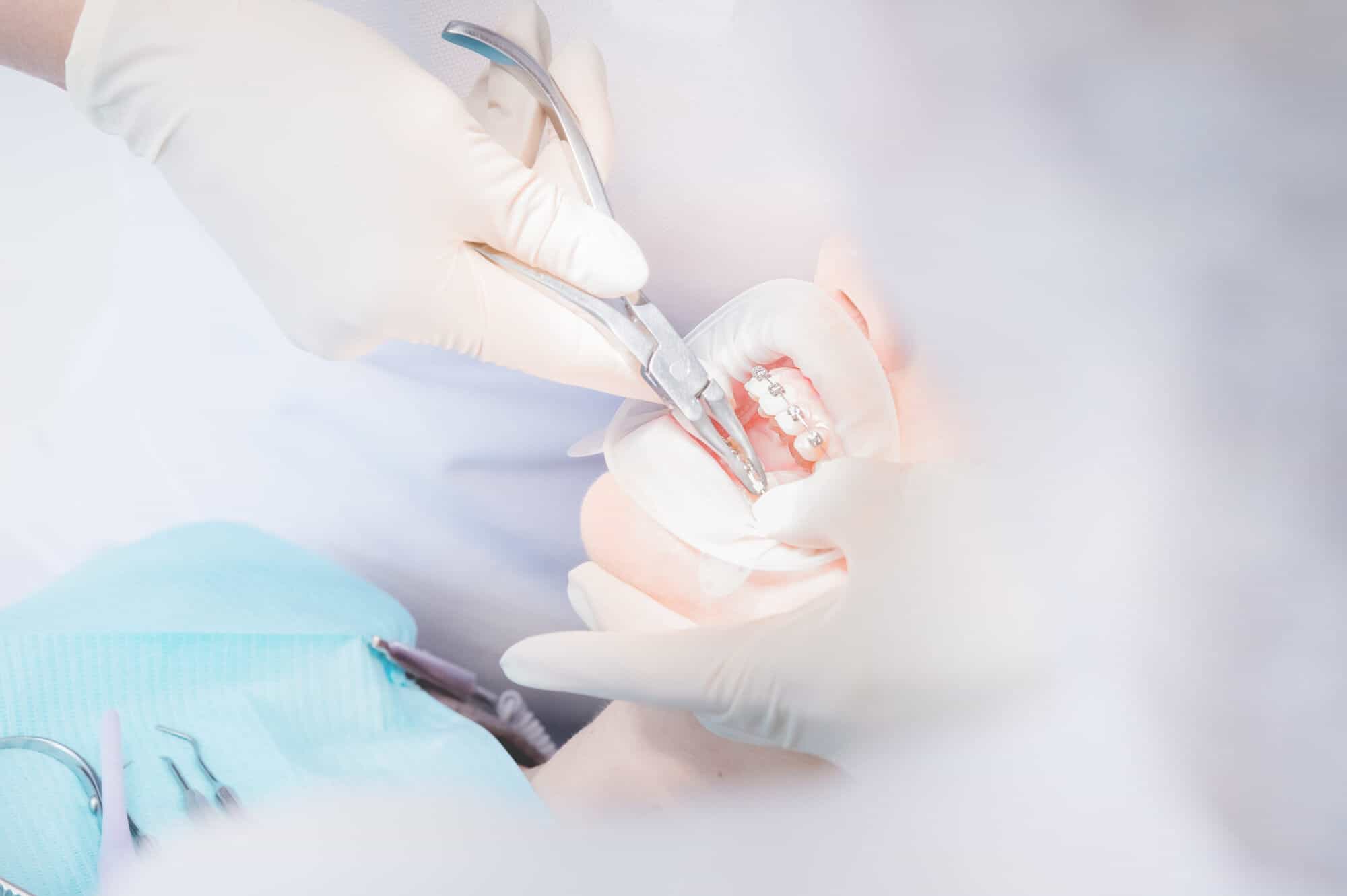 How to Remove Braces at Home and Why You Shouldn't Do It