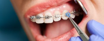 how are braces tightened