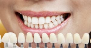 can bonded teeth be whitened