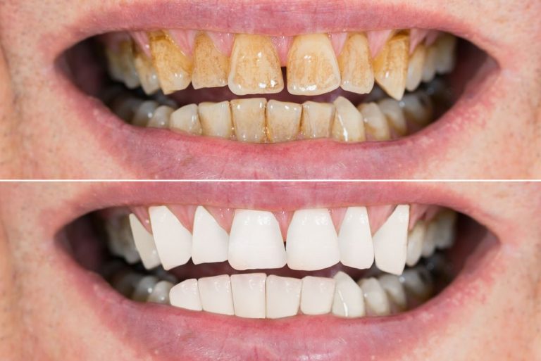 Brown Stains on Teeth? How to Remove Them Quickly