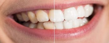 brown stains on teeth