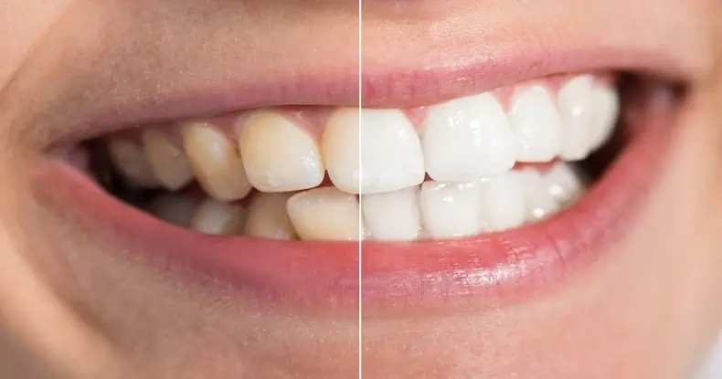 brown stains on teeth