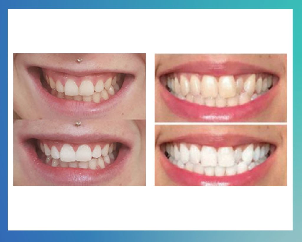 Whitening teeth before and after