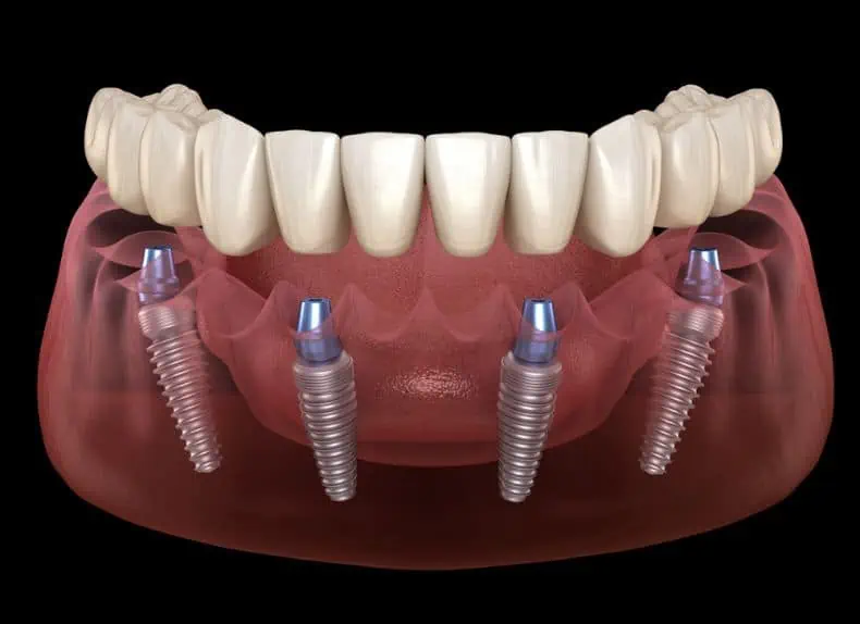 Dentist in Bulgaria Cost Dental Implants and Best Dental Clinics