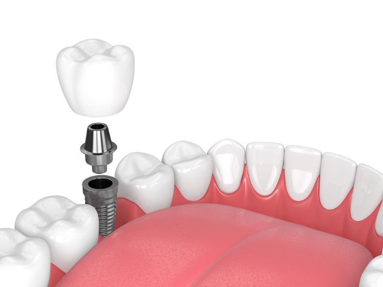 Dentist in Bulgaria Cost Dental Implants and Best Dental Clinics