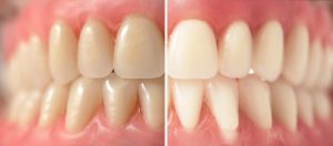 teeth bleaching before and after pictures