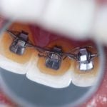46189What are Damon Braces? Your Guide to Cost, Reviews and More!