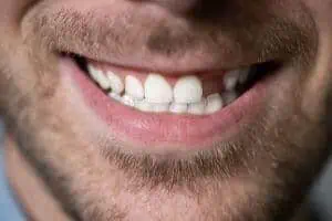 one tooth denture cost
