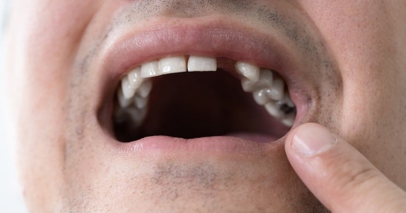 What happens if you don't replace a missing tooth?