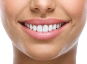 trusmile veneers coupon