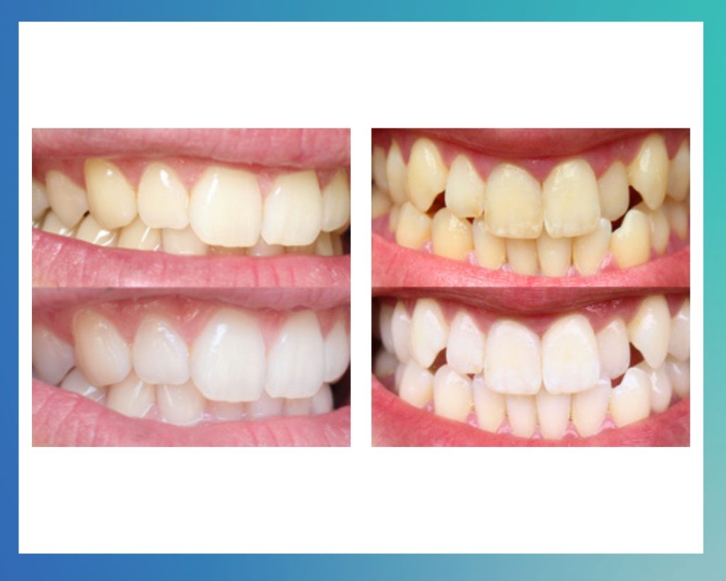 teeth bleaching results