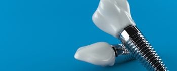 $399 dental implants
