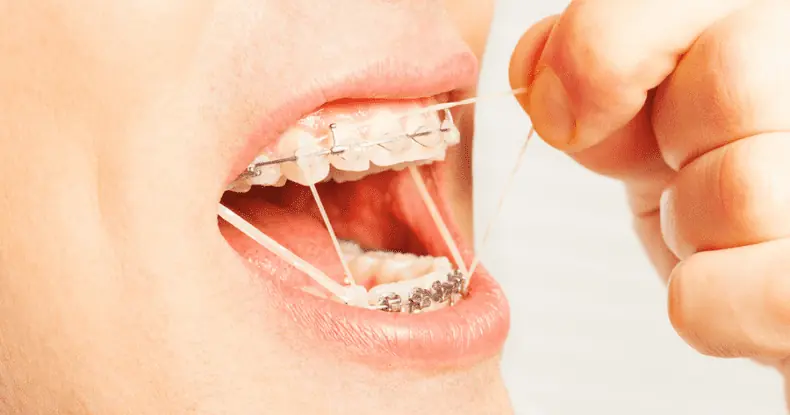 rubber bands for braces