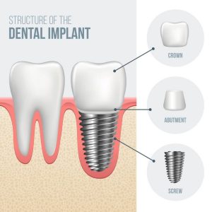 teeth replaced in one day