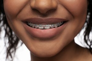 free braces programs