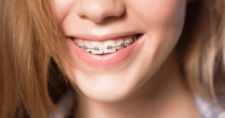 metal braces