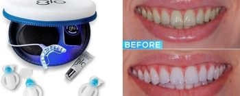 glo teeth whitening