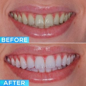 glo teeth whitening before and after