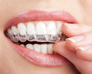 white braces vs clear aligners 