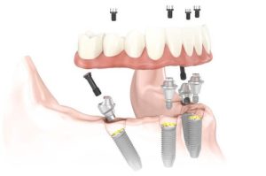 teeth in a day