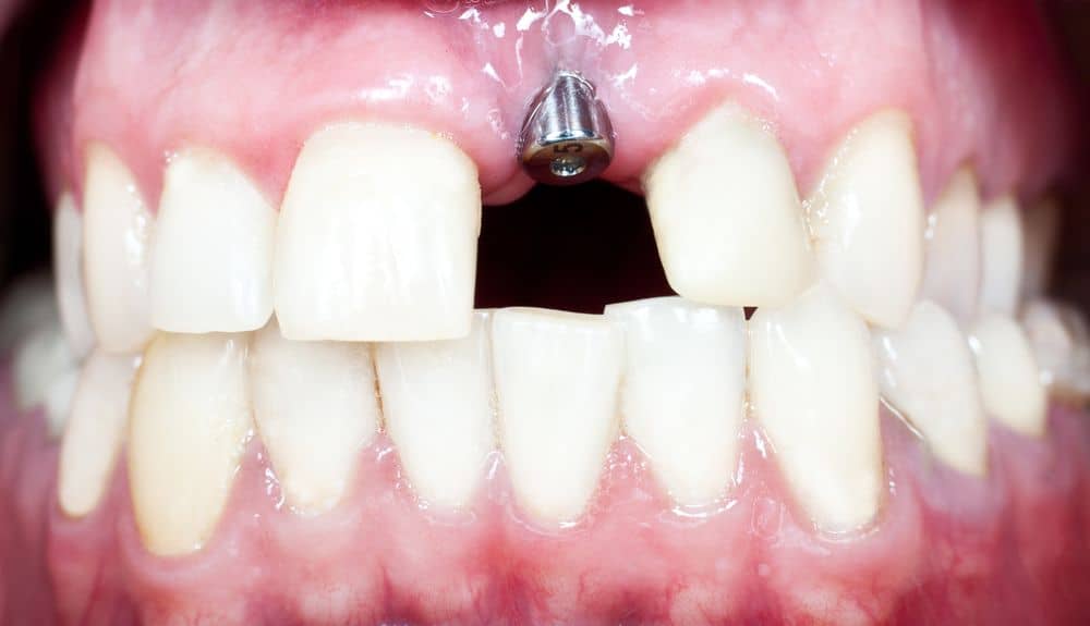 Zirconia vs Titanium Dental Implants Which are Better?