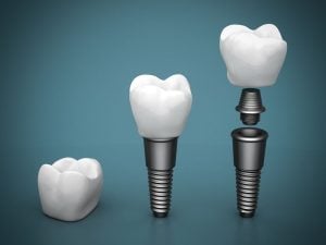 dental implants titanium vs zirconium