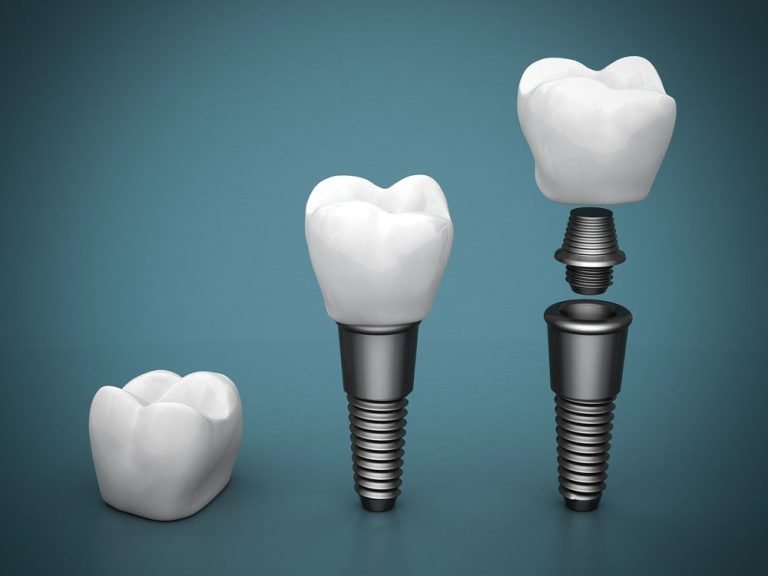 Zirconia vs Titanium Dental Implants Which are Better?