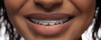 free braces