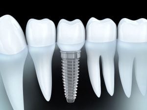 dental implant titanium or zirconium
