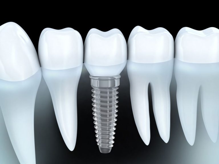 Zirconia vs Titanium Dental Implants Which are Better?