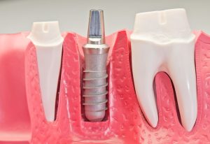 zirconia abutment vs titanium