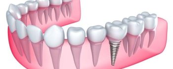 zirconia vs titanium implants