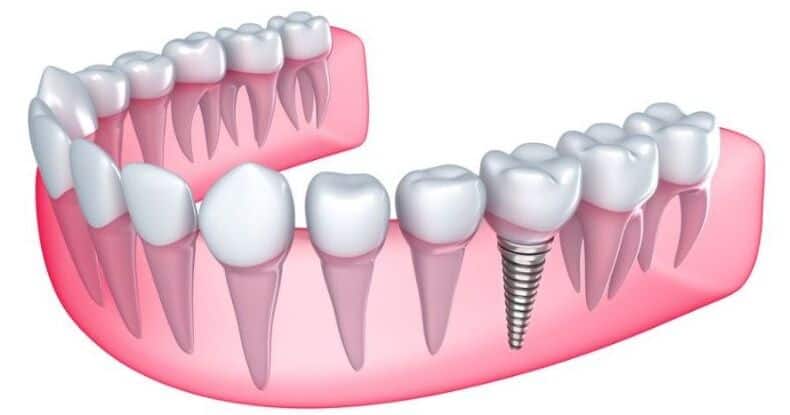 zirconia vs titanium implants