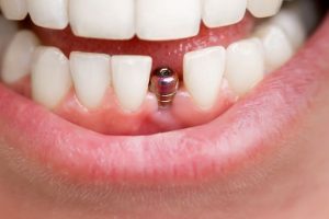 can you have dental implants with receding gums