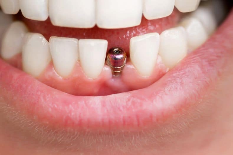 Can You Have Dental Implants with Receding Gums?