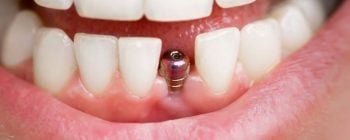 teeth implants with receding gums