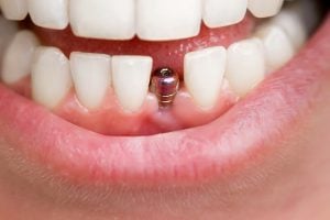 dental implant abutment showing