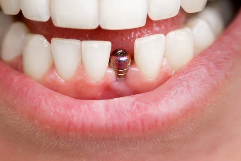 Dental Implant Showing Through Gum What Should You Do?