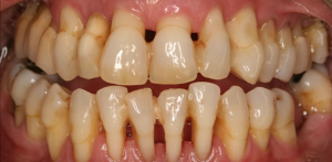 periodontal disease