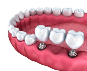 implant-supported bridge