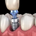 57551Zirconia vs Titanium Dental Implants: Which is the Better Option?